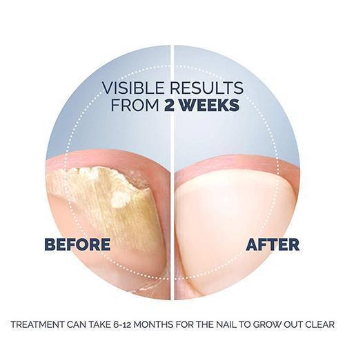 Fungal Nail Treatment Kit - Image 4